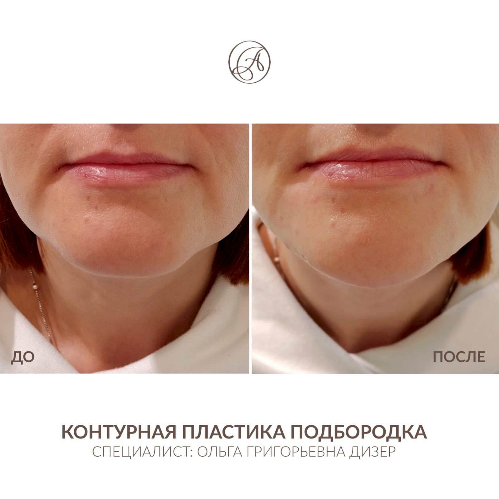 Контурная пластика 7
