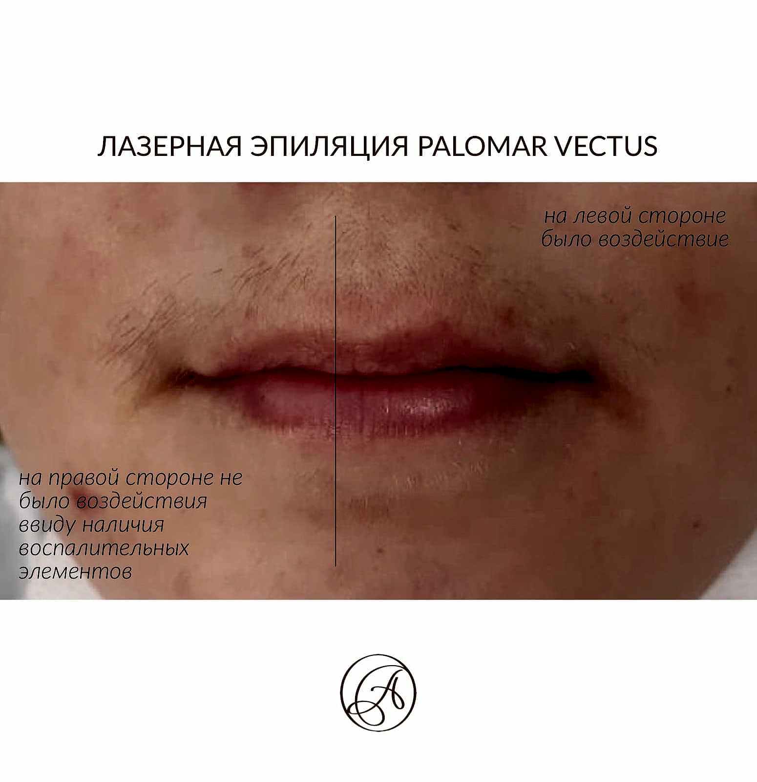 Лазерная эпиляция 2